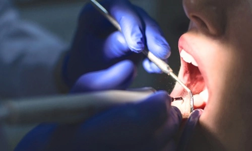 Tooth Worth in a Lawsuit