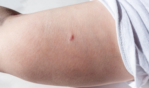 Nexplanon Lawsuit