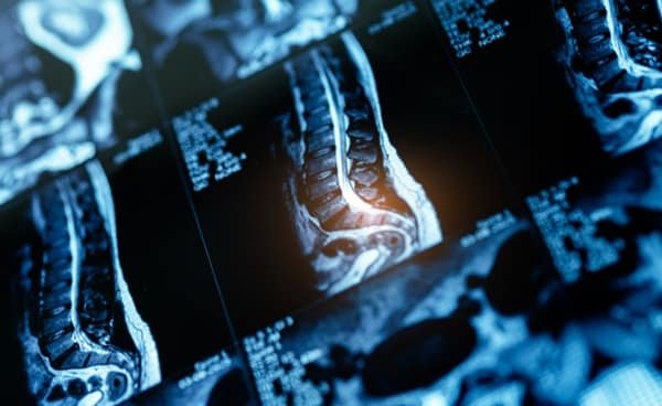 Beyond the Accident: Turning a Spinal Cord Injury into a Legal Fighting Chance