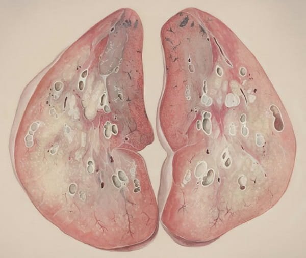 Types of Compensation Available in Alabama Mesothelioma Cases